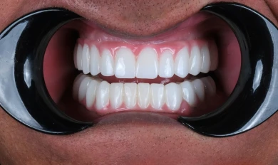 Zubné implantáty