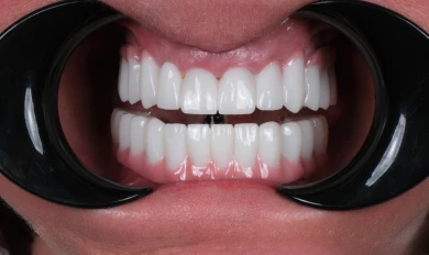 Zubné implantáty
