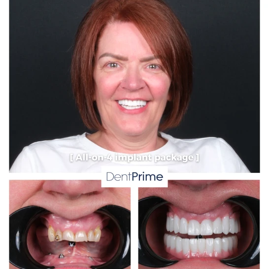 Zubné implantáty Before After