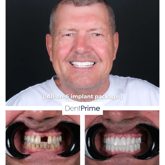 Zubné implantáty Before After