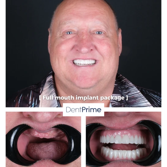 Zubné implantáty Before After