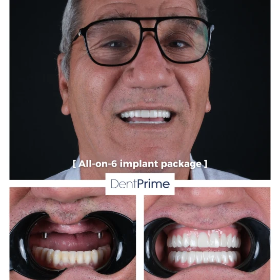 Zubné implantáty Before After