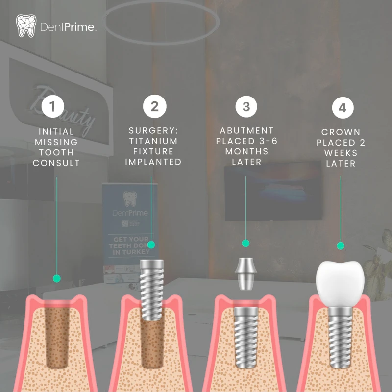 Ako prebieha implantácia?