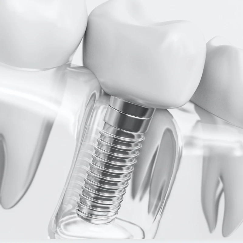 Čo sú zubné implantáty v Turecku?