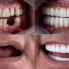 Koľko stojí kompletný zubný implantát v Turecku?